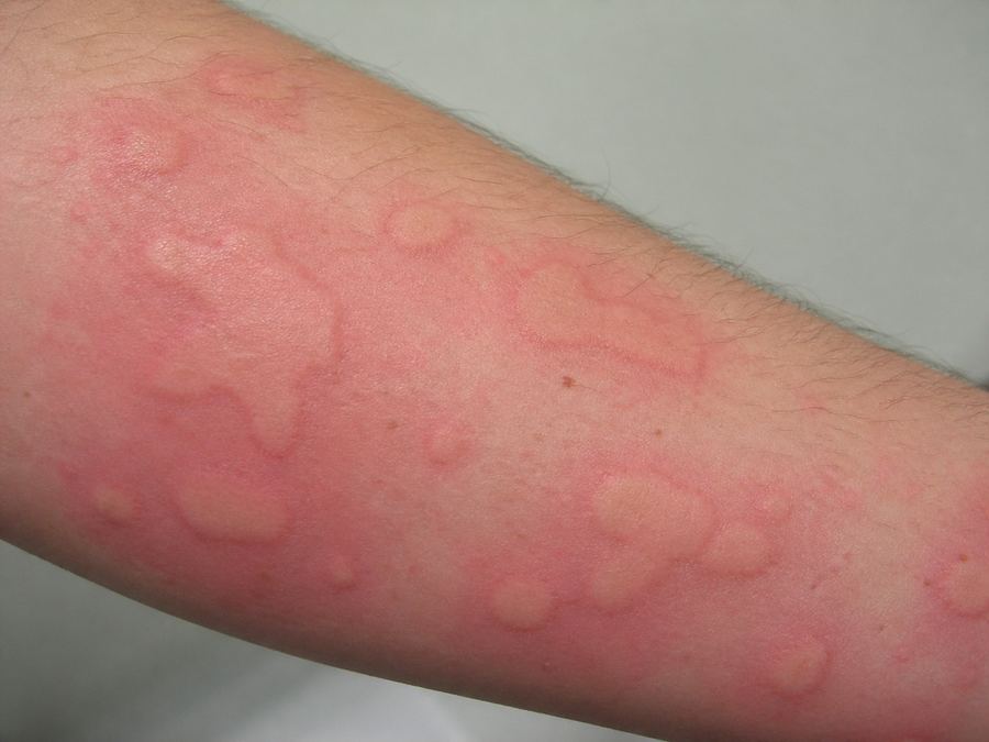 Raised hives on a forearm, an example of chronic spontaneous urticaria