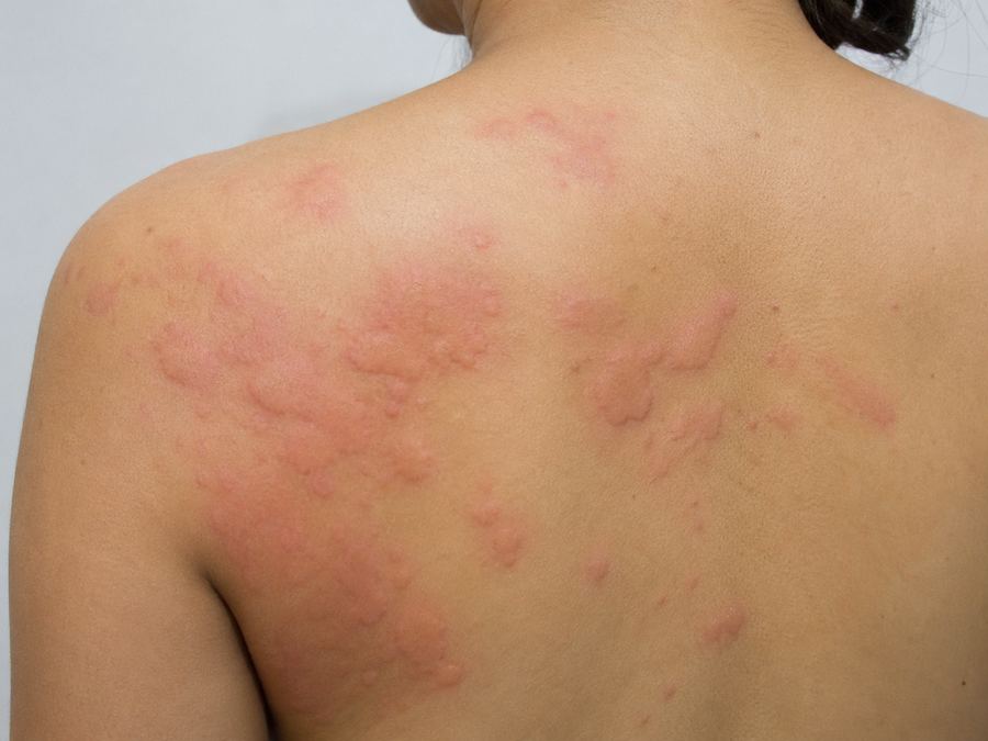 Widespread hives across the back, an example of chronic spontaneous urticaria